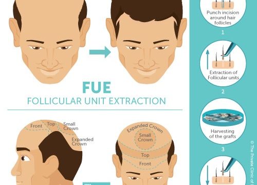 FUE hair transplant procedure advices