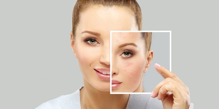 Top 3 acne issues causes