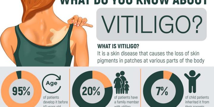 How is vitiligo treated?